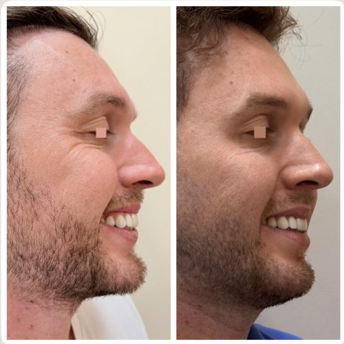 Nito belle Botox depois